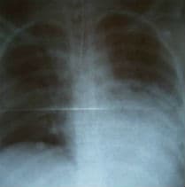 tüdőgyulladás